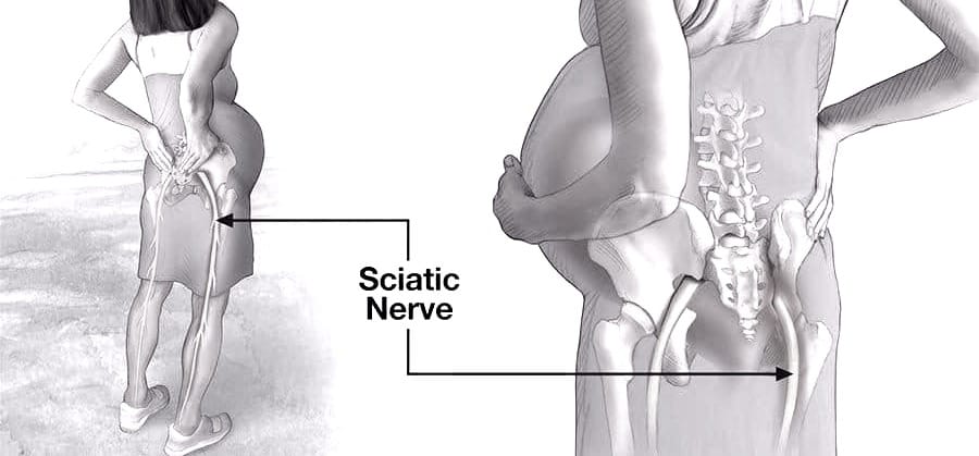 Pregnancy and sciatica