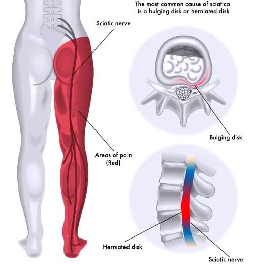 Sciatic nerve 