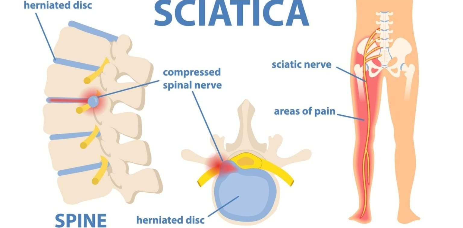 Sciatica Causes