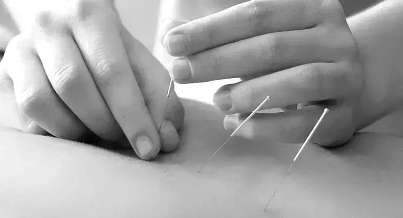 Acupuncture