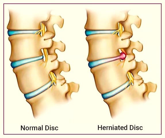 Cervical Disc Herniation