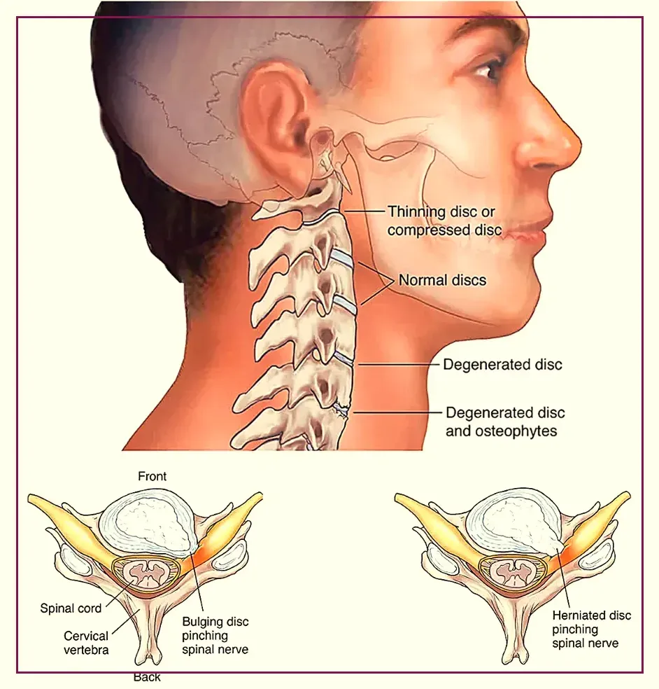 Chronic Neck Pain