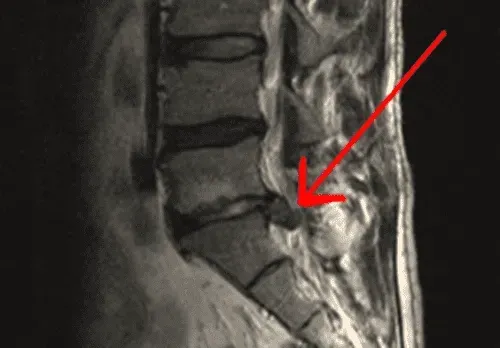 MRI in Diagnosing Sciatica