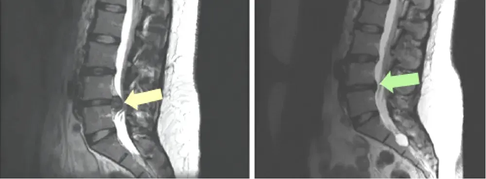 What type of MRI is recommended for Sciatica pain