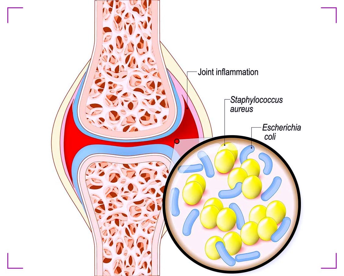 Septic Arthritis