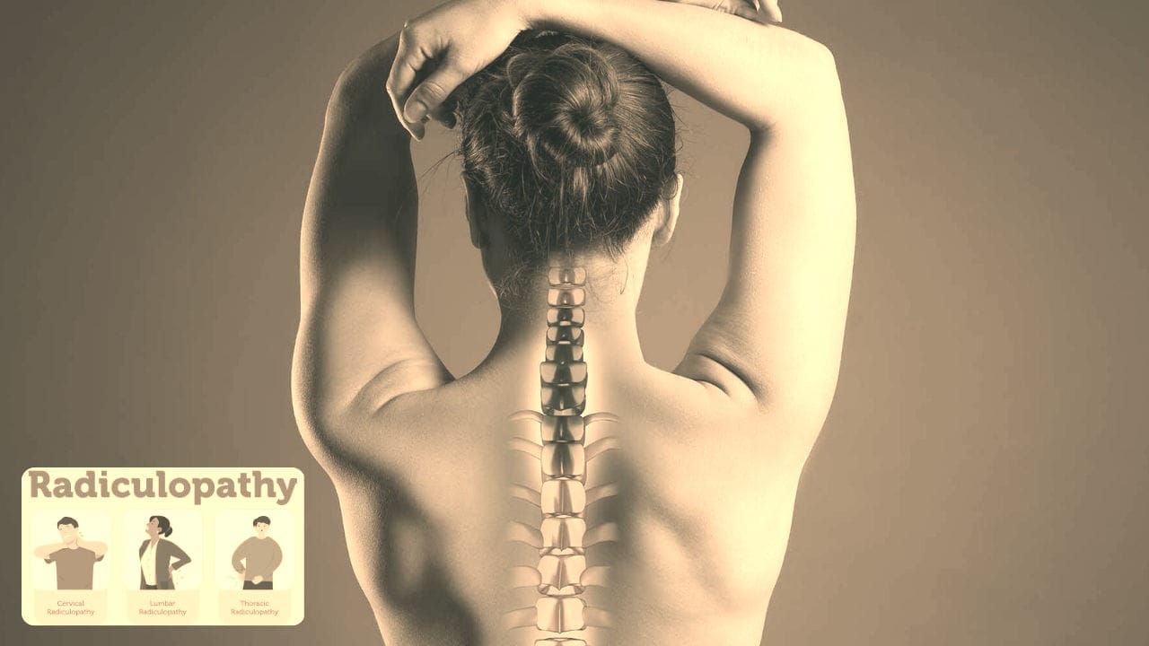 Causes of Radiculopathy