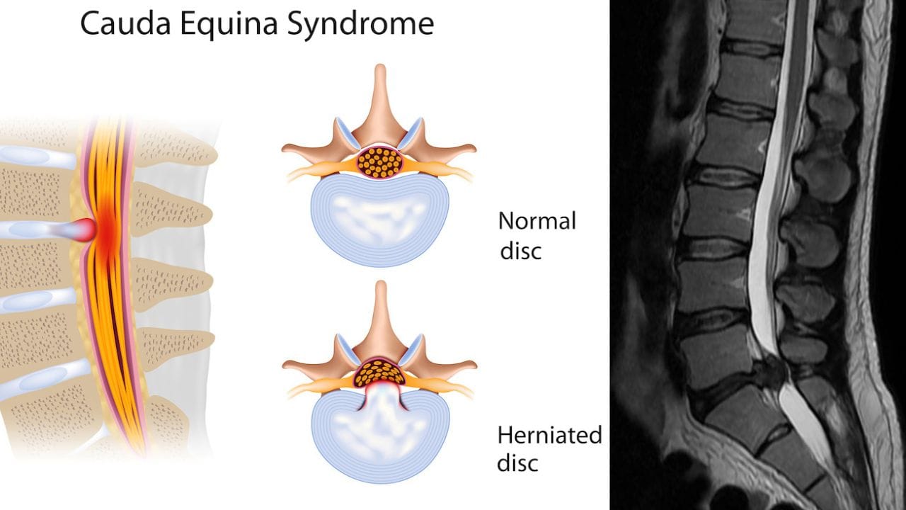 Cauda Equina Syndrome