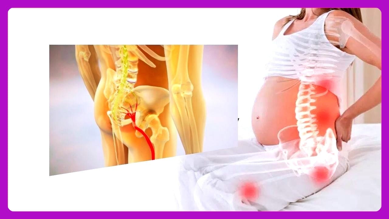 Sciatica During Pregnancy