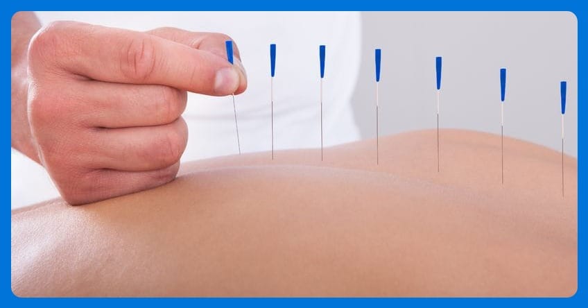 Acupuncture for Sciatica