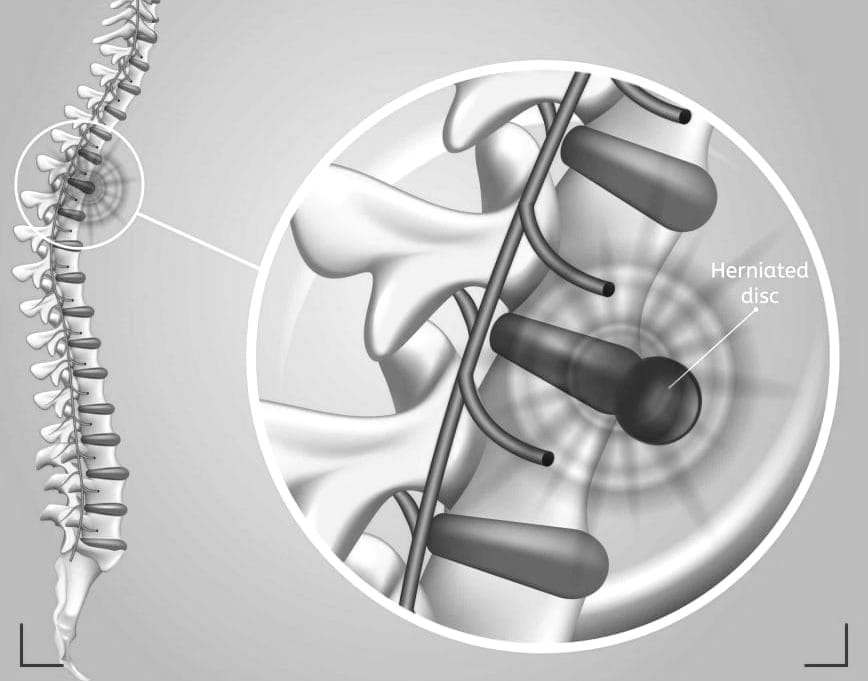 Symptoms of Herniated Disc