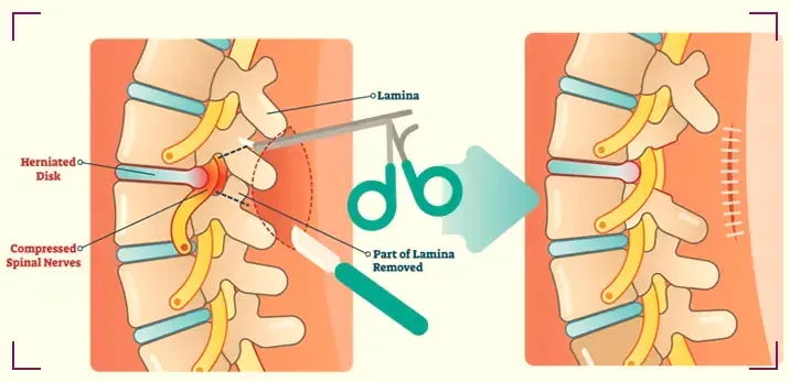 Surgical Treatment