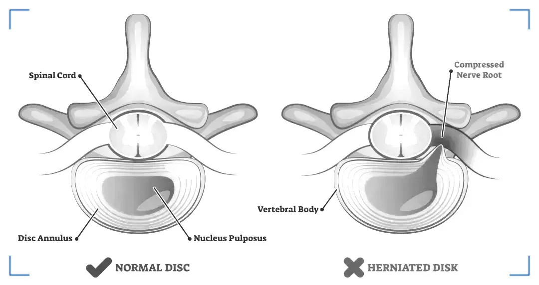 Herniated Disc