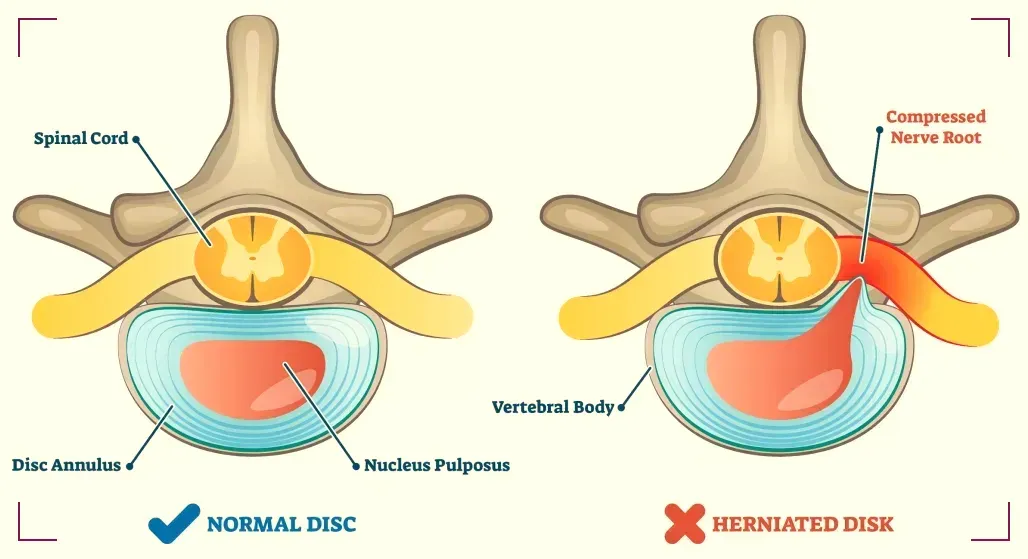 Herniated Disc