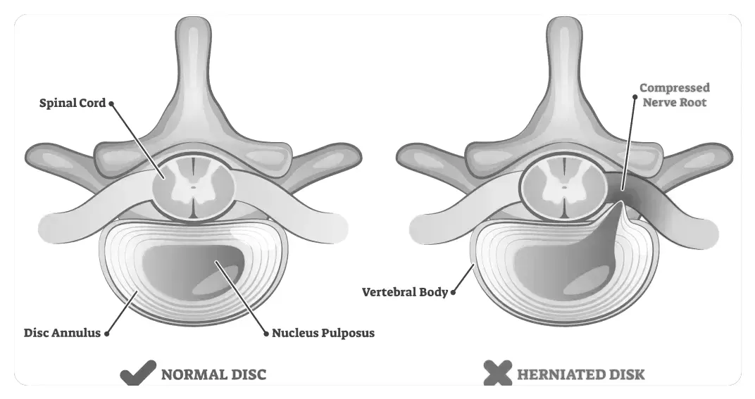 Herniated Disc