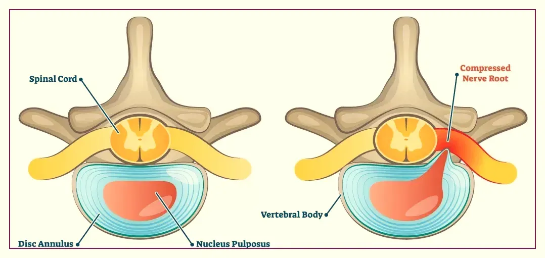 Herniated Disc