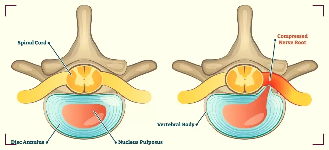 Herniated Disc