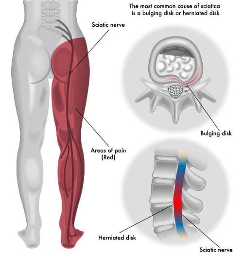 Sciatica