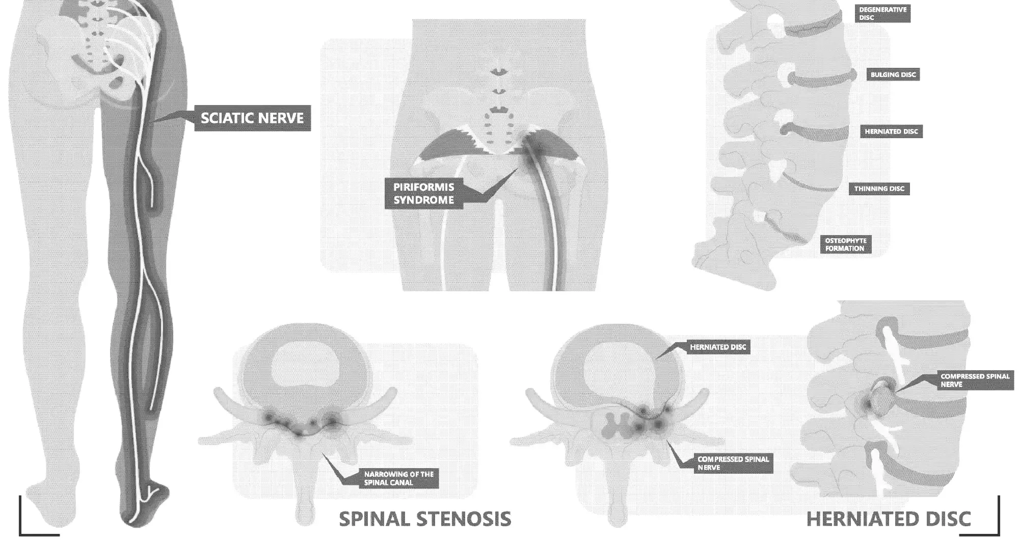 Symptoms of Sciatica