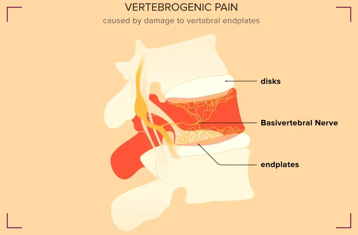 Vertebrogenic Low Back Pain