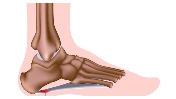 Understanding Plantar Fasciitis