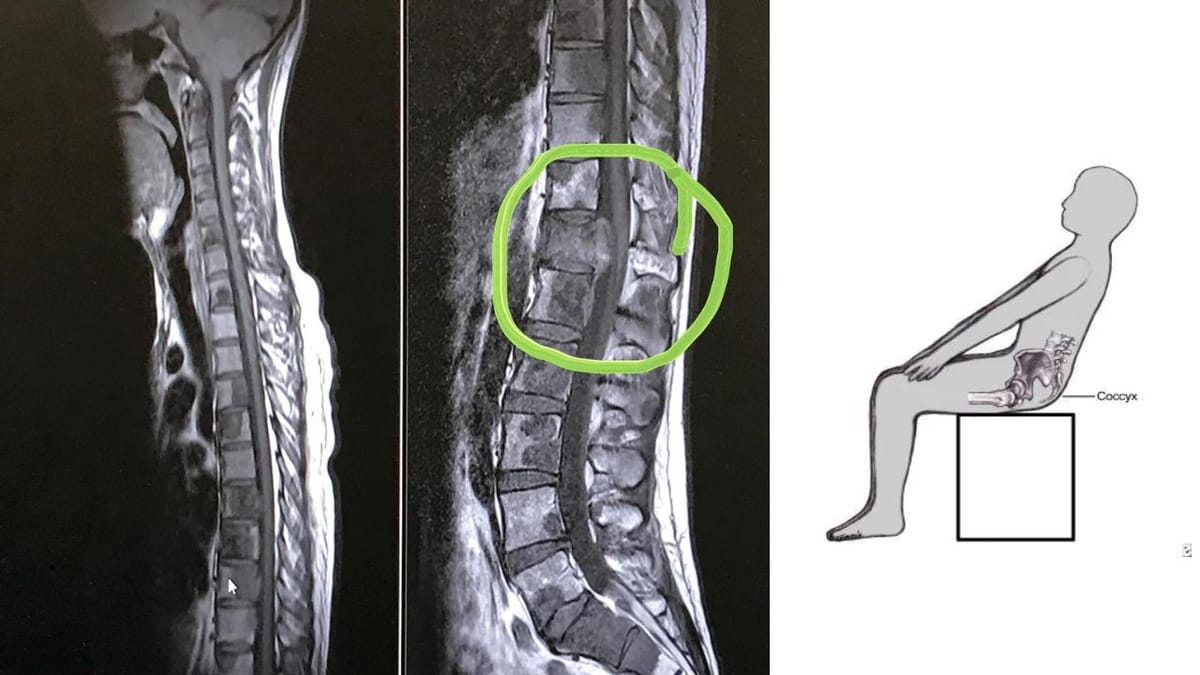 Can Coccyx Pain Be Cancer?