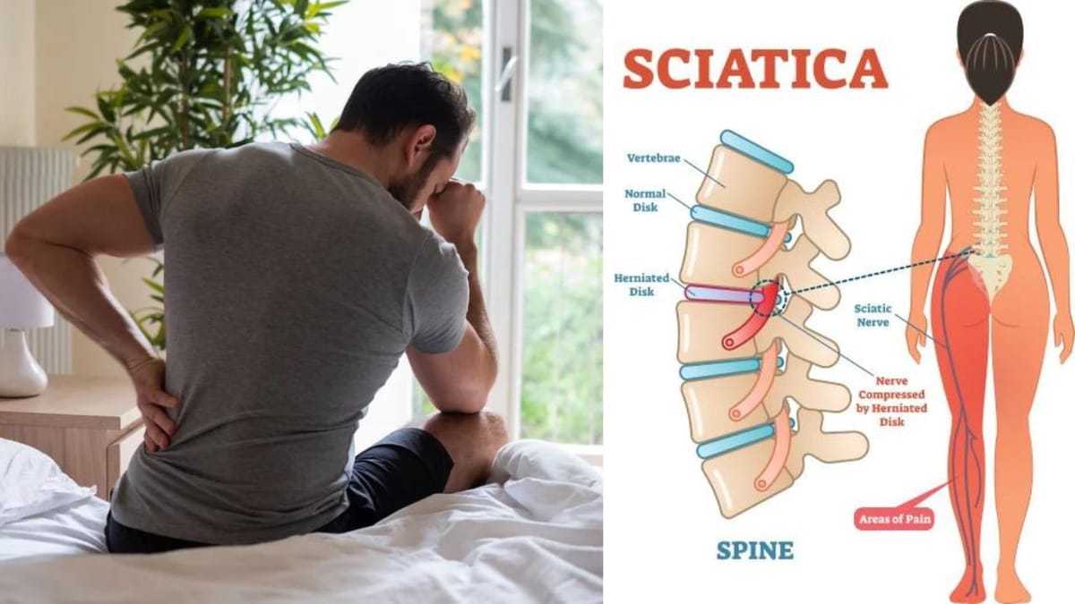 Signs of Sciatica Improving