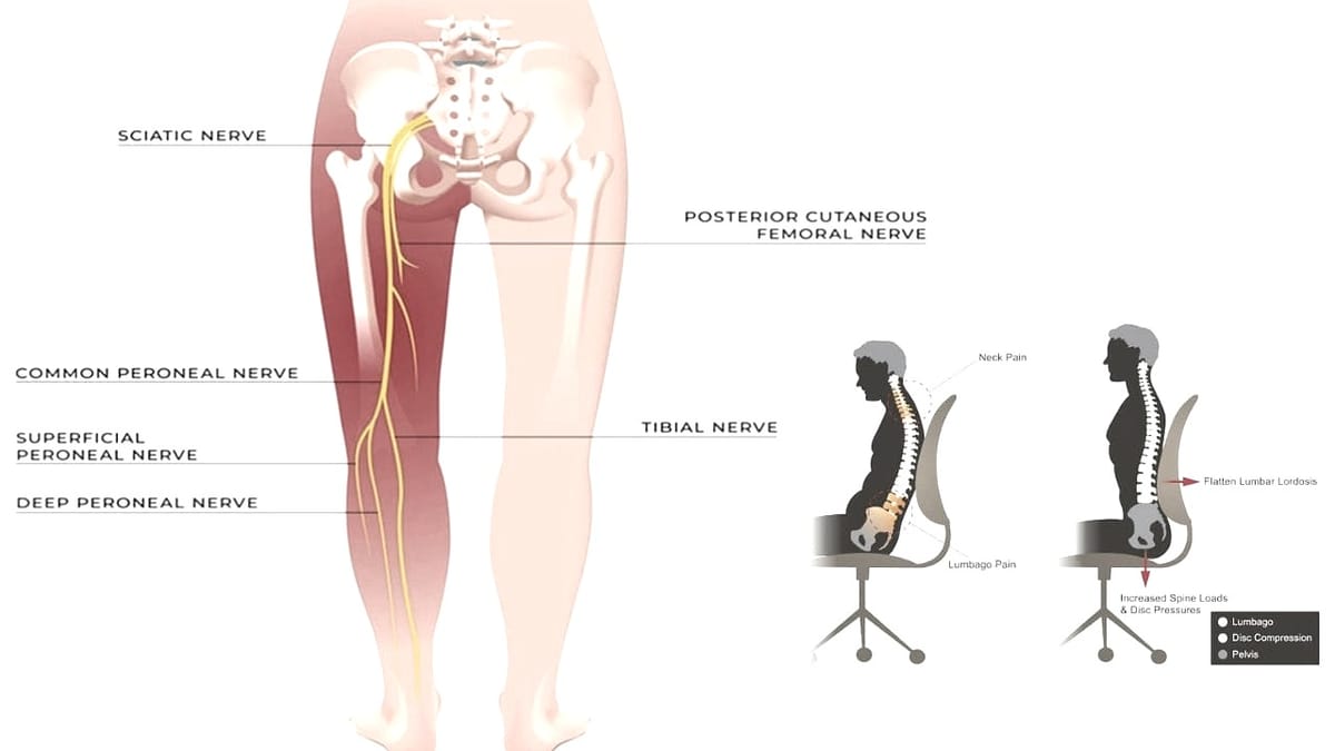 Does Sitting Make Sciatica Worse? Unraveling the Impact