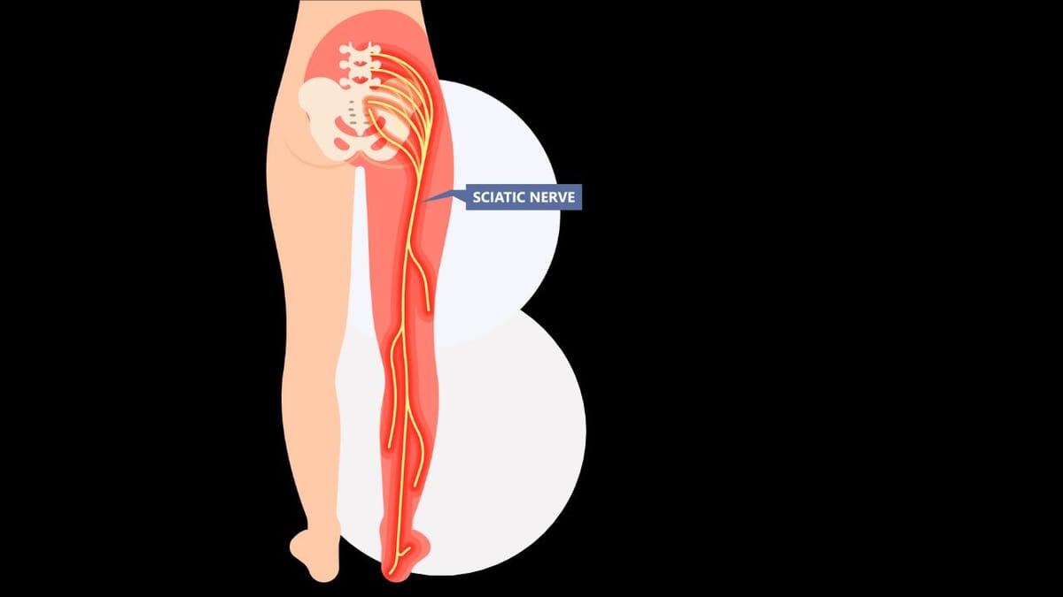 What Is The Most Effective Pain Relief For Sciatica?