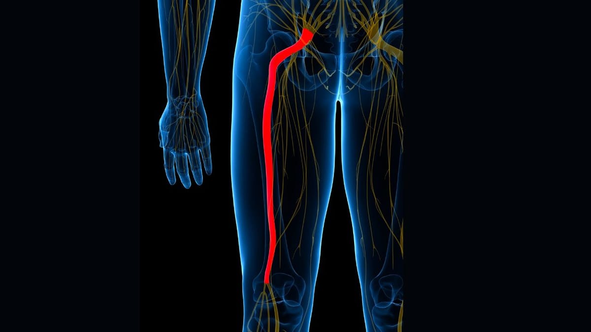 What Is Sciatica?