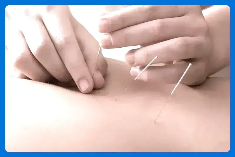 Acupuncture For Sciatica: A Natural Path to Relief