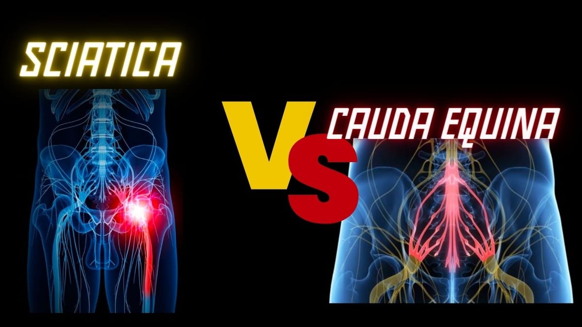 Cauda Equina vs Sciatica