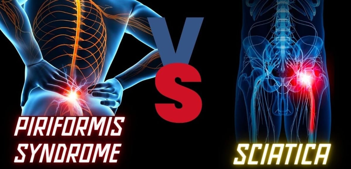 Piriformis Syndrome vs Sciatica