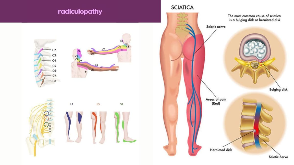 Sciatica vs Radiculopathy