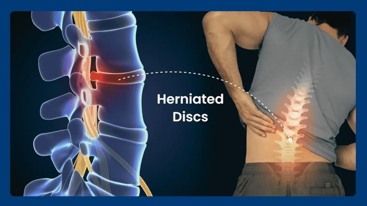 Herniated Disc & Their Impact on Daily Life