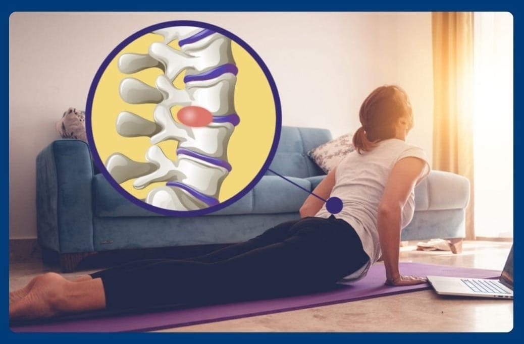 Herniated Disc Treatment: How To Alleviate Pain & Restore Mobility