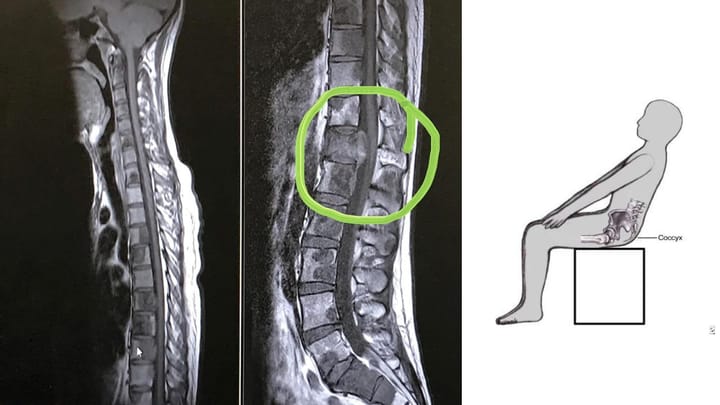 Can Coccyx Pain Be Cancer