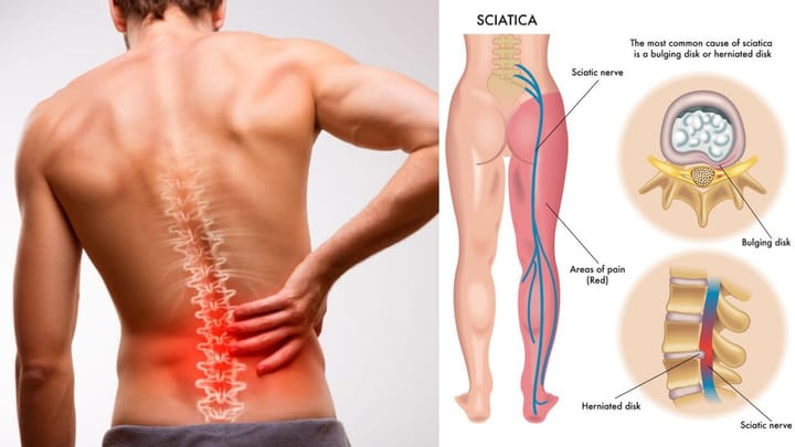 What Can Make Sciatica Worse?