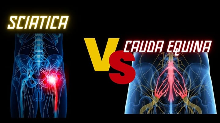 Cauda Equina vs Sciatica