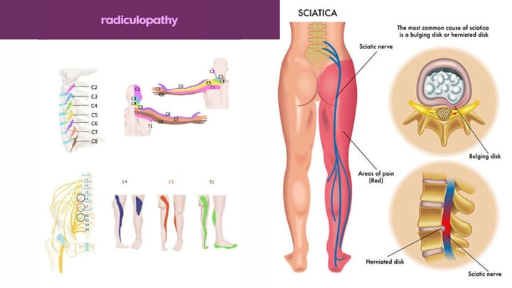 Sciatica vs Radiculopathy